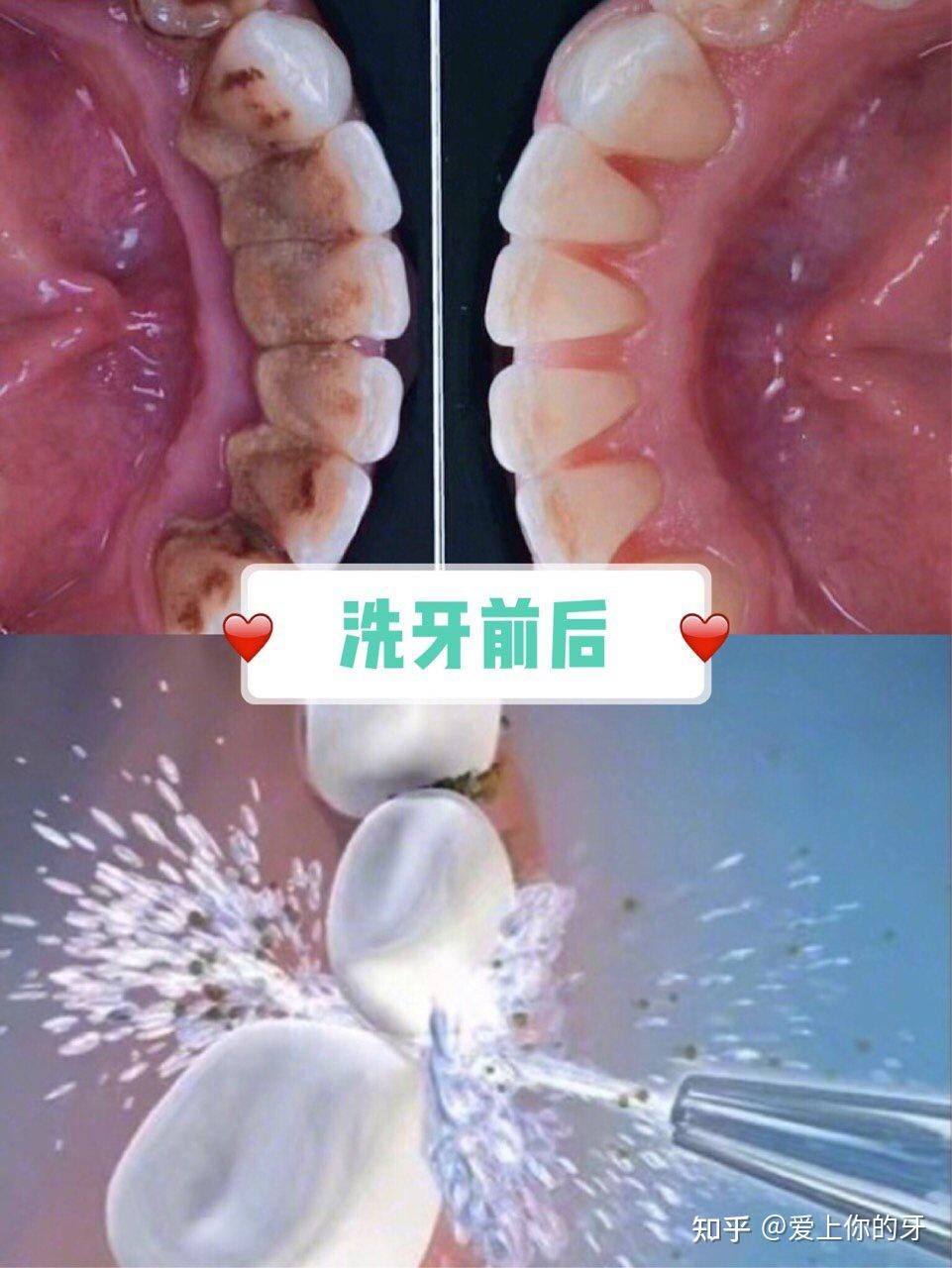 太原洗牙可以用医保吗(洗牙可以用医保吗,报销比例多少)